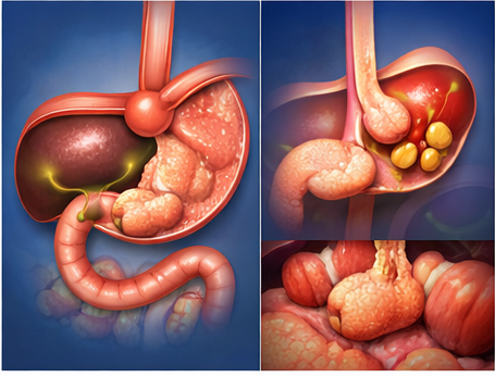 Cirugía antirreflujo y hernia hiatal